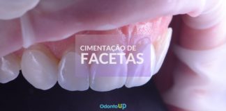 9 Passos Para Cimentação de Faceta de Porcelana
