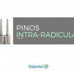 Pinos Intrarradiculares