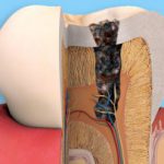 ENDODONTIA-300×203