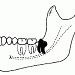 distoangular