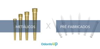 Pinos Metálicos X Pinos de Fibra Pré-Fabricados