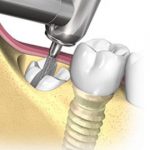 terceiro-molar