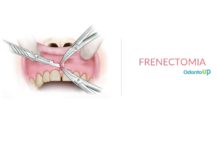 Frenectomia