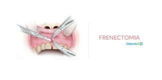 Frenectomia