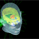 radioterapia