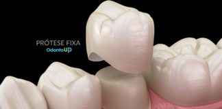 Protese Fixa
