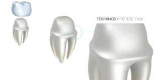 Tipos de Términos em Prótese Fixa