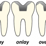 inlay imagem