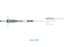 Técnica Anestésica Pterigomandibular e Bloqueio do Nervo Mentual e Palatino Maior