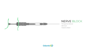 Técnica Anestésica Pterigomandibular e Bloqueio do Nervo Mentual e Palatino Maior