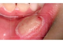 Você Sabe Como Tratar Mucosite? Novo Conceito no Tratamento