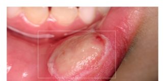 Você Sabe Como Tratar Mucosite? Novo Conceito no Tratamento