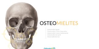 Osteomielites