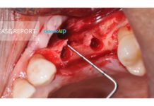 Regeneração Óssea Guiada (ROG) Review + Caso Clínico