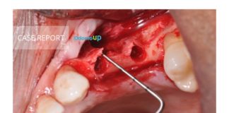 Regeneração Óssea Guiada (ROG) Review + Caso Clínico