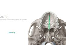 MARPE (Micro-Implant-Assisted Rapid Palatal Expander)