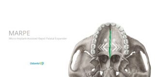 MARPE (Micro-Implant-Assisted Rapid Palatal Expander)
