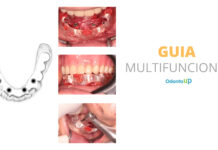 Guia Multifuncional em Implantodontia e Prótese
