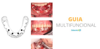 Guia Multifuncional em Implantodontia e Prótese