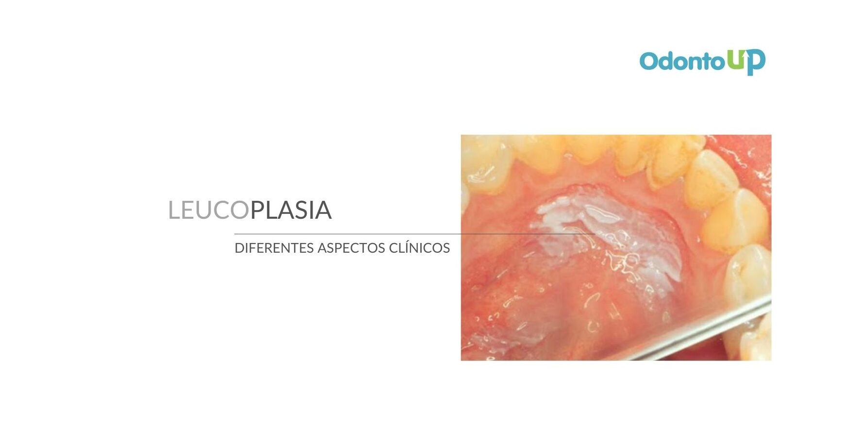 LEUCOPLASIA