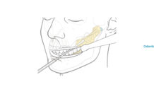 Vídeo da Cirurgia de Bichectomia | Buccal Fat Pad Excision