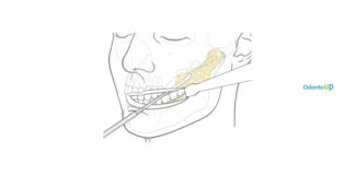 Vídeo da Cirurgia de Bichectomia | Buccal Fat Pad Excision