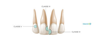 Preparos e Restaurações Classe III, IV e V em Resina Composta